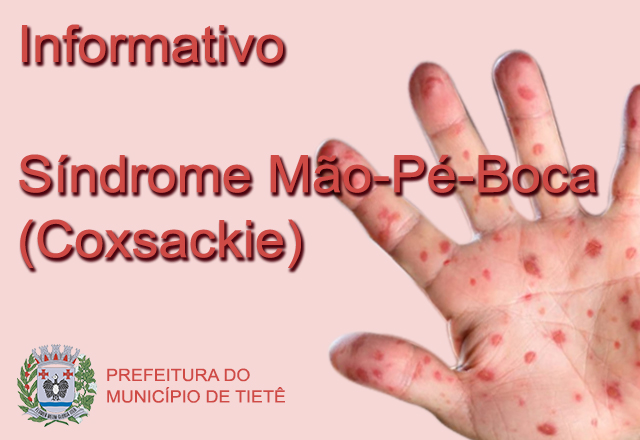 Vigilância em Saúde divulga informativo sobre a Síndrome Mão-Pé-Boca